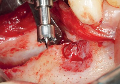 MEISINGER Trephine Ejection Kit by. Prof. Dr. Khoury, BTE00