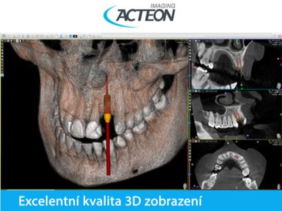 CBCT 3D plánování implantátů2