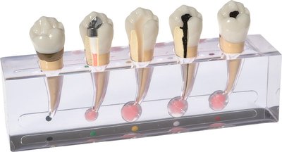 Endodontiemodell „Granulom“ P23-END.2