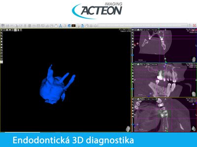 CBCT 3D endodontická diagnostika4