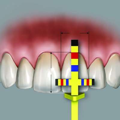 Chu Gauges T-BAR refill tips 3pcs./pack.