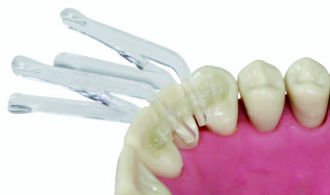 Clip & Splint aplikační svorky, 30ks