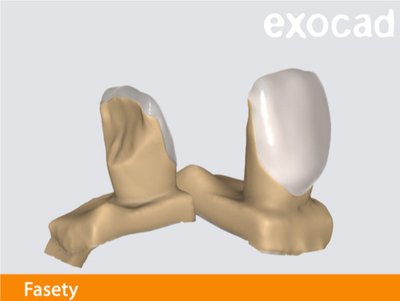 Exocad fasety