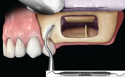 HU-FRIEDY C36/376 Dłuto kostne back action, Bone Chisel #C36/37