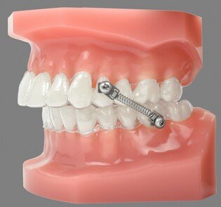 CS5- korektor zgryzu do Alignerów do klasy II i III Zestaw dla 5 pacjentów KIT Twist Lock Pivot/ 7mm Spring