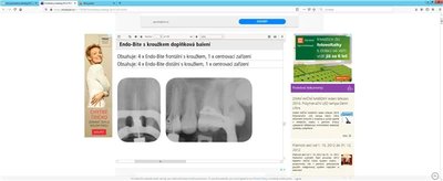Endo-Bite set 2+2 ks + centr. 2 ks