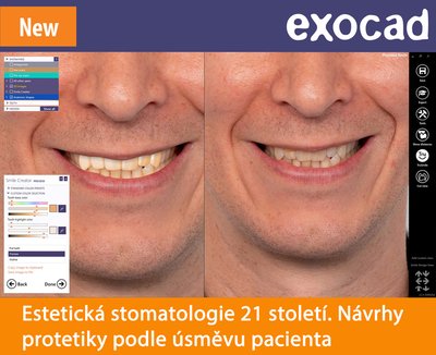 Exocad Smile Creator