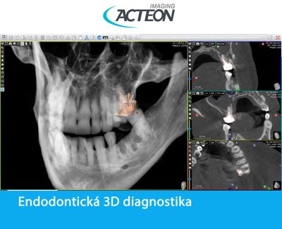 CBCT 3D endodontická diagnostika5