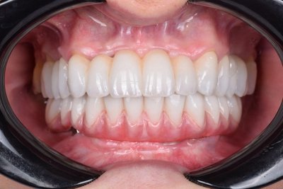 Bloomden zirkonové puky 3D Pro |98*18 mm| - A4