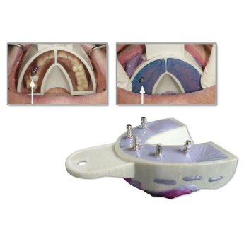 MIRATRAY IMPLANT OK S2 otiskovací lžíce horní 6ks