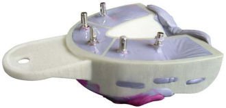 Miratray Implant horní S3, 6ks