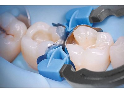 POLYDENTIA - QuickmatFIT sectional matrices 0,04 molar 100 pcs