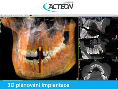 CBCT 3D implantologické plánování