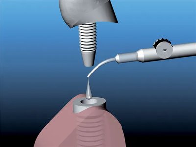 Gapseal náhr. špičky 10ks