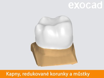 Exocad kapny, redukované korunky a můstky
