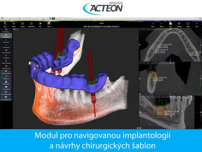CBCT 3D modul pro návrhy chirurgických šablon