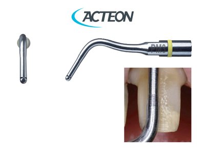 Acteon Satelec PM3 - Minimálně invazivní preparace preparace na zaoblený schůdek (leštění) bez krvácení