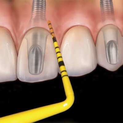 Colorvue Tips #11, 12 tips/pack., 3-6-8-11