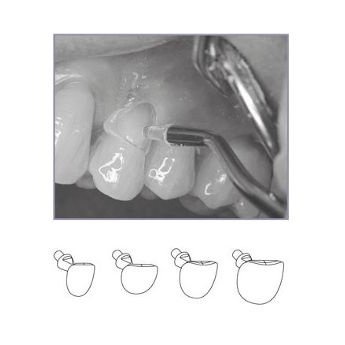 LM Cervical Matrices assortiments 120ks