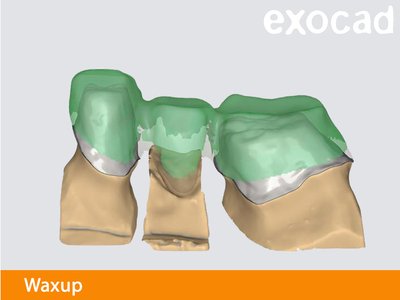 Exocad waxup