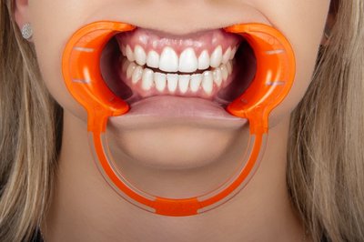 Rozwierak policzkowy 2 szt. COTISEN - S