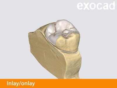 Exocad Inlay/onlay