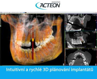 CBCT 3D plánování implantátů3