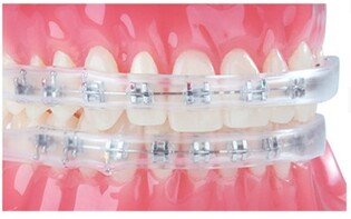 Osłona na zamki Dynaflex / 1 szt (zestaw góra /dół) Comfort Covers For Orthodontic Braces