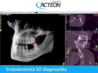 CBCT 3D endodontická diagnostika2